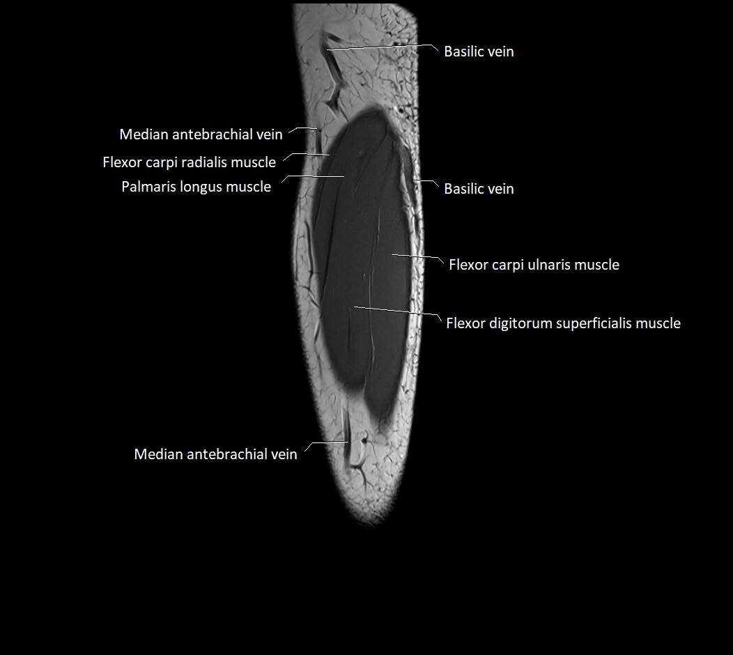 MRI 3T forearm sagittal labelled cross sectional anatomy image 36.webp
